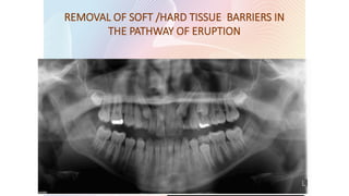 • Retained deciduous teeth
• Supernumerary teeth
• Fibrous/ Bony obstruction of the erupting
tooth bud
• Impacted teeth
REMOVAL OF SOFT /HARD TISSUE BARRIERS IN
THE PATHWAY OF ERUPTION
 