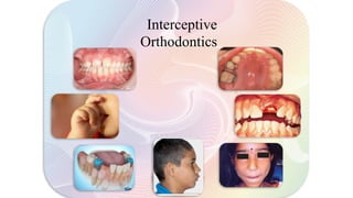 Serial extraction
Dev. Cross bite
Abnormal habits
Space regaining
Muscle exercises
Removal of barrier-
eruption
Interceptive
Orthodontics
Interception of
skeletal
malrelation
 