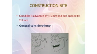 CONSTRUCTION BITE
• Mandible is advanced by 4-5 mm and bite opened by
2-3 mm
• General considerations-
 