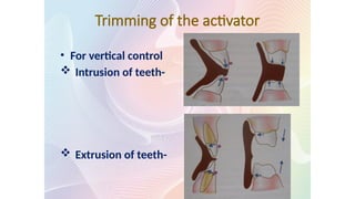 Trimming of the activator
• For vertical control
 Intrusion of teeth-
 Extrusion of teeth-
 