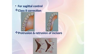 • For sagittal control
Class II correction
Protrusion & retrusion of incisors
 