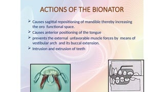 ACTIONS OF THE BIONATOR
 Causes sagittal repositioning of mandible thereby increasing
the oro functional space.
 Causes anterior positioning of the tongue
 prevents the external unfavorable muscle forces by means of
vestibular arch and its buccal extension.
 Intrusion and extrusion of teeth
 