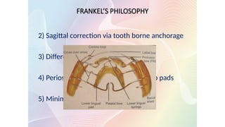 FRANKEL’S PHILOSOPHY
2) Sagittal correction via tooth borne anchorage
3) Differential eruption guidance
4) Periosteal pull by buccal shields & lip pads
5) Minimal maxillary basal effect
 