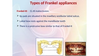 Frankel-III - CL-III malocclusion.
 lip pads are situated in the maxillary vestibular labial sulcus.
 Labial bow rests against the mandibular teeth
 There is a protrusive bow similar to that of Frankel-II
Types of Frankel appliances
 