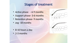 Stages of treatment
• Active phase – 6-9 months
• Support phase- 3-6 months
• Retention phase- 9 months
• avg- 18 months
• 8-10 hours a day
• 2-3 months
 