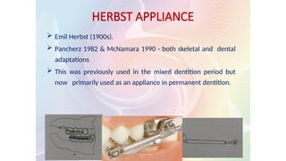  Emil Herbst (1900s).
 Pancherz 1982 & McNamara 1990 - both skeletal and dental
adaptations
 This was previously used in the mixed dentition period but
now primarily used as an appliance in permanent dentition.
HERBST APPLIANCE
 