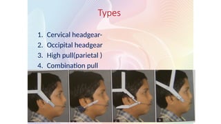 Types
1. Cervical headgear-
2. Occipital headgear
3. High pull(parietal )
4. Combination pull
 