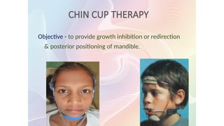 CHIN CUP THERAPY
Objective - to provide growth inhibition or redirection
& posterior positioning of mandible.
 
