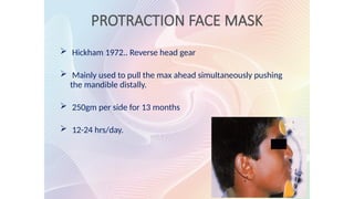 PROTRACTION FACE MASK
 Hickham 1972.. Reverse head gear
 Mainly used to pull the max ahead simultaneously pushing
the mandible distally.
 250gm per side for 13 months
 12-24 hrs/day.
 