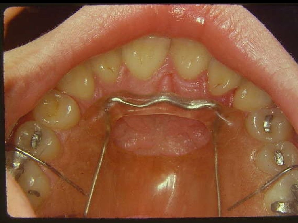 Interceptive orthodontics