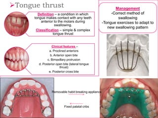 Definition – a condition in which
tongue makes contact with any teeth
anterior to the molars during
swallowing.
Classification – simple & complex
tongue thrust
Clinical features –
a. Proclined anteriors
b. Anterior open bite
c. Bimaxillary protrusion
d. Posterior open bite (lateral tongue
thrust)
e. Posterior cross bite
Tongue thrust
Removable habit breaking appliance
Fixed palatal cribs
Management
-Correct method of
swallowing
-Tongue exercises to adapt to
new swallowing pattern
 