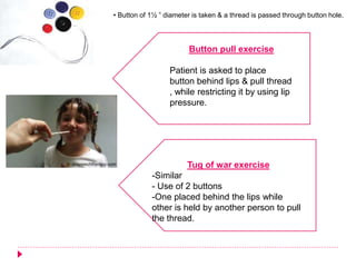 • Button of 1½ ” diameter is taken & a thread is passed through button hole.
Button pull exercise
Patient is asked to place
button behind lips & pull thread
, while restricting it by using lip
pressure.
Tug of war exercise
-Similar
- Use of 2 buttons
-One placed behind the lips while
other is held by another person to pull
the thread.
 