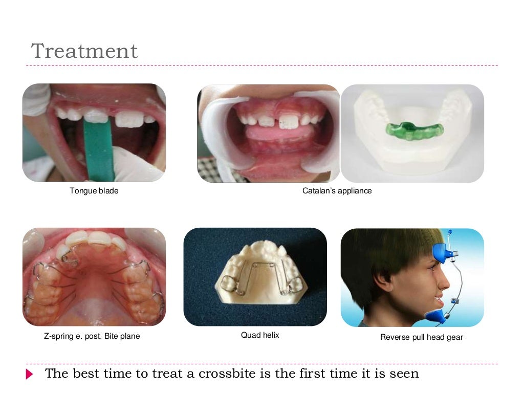 Interceptive orthodontics