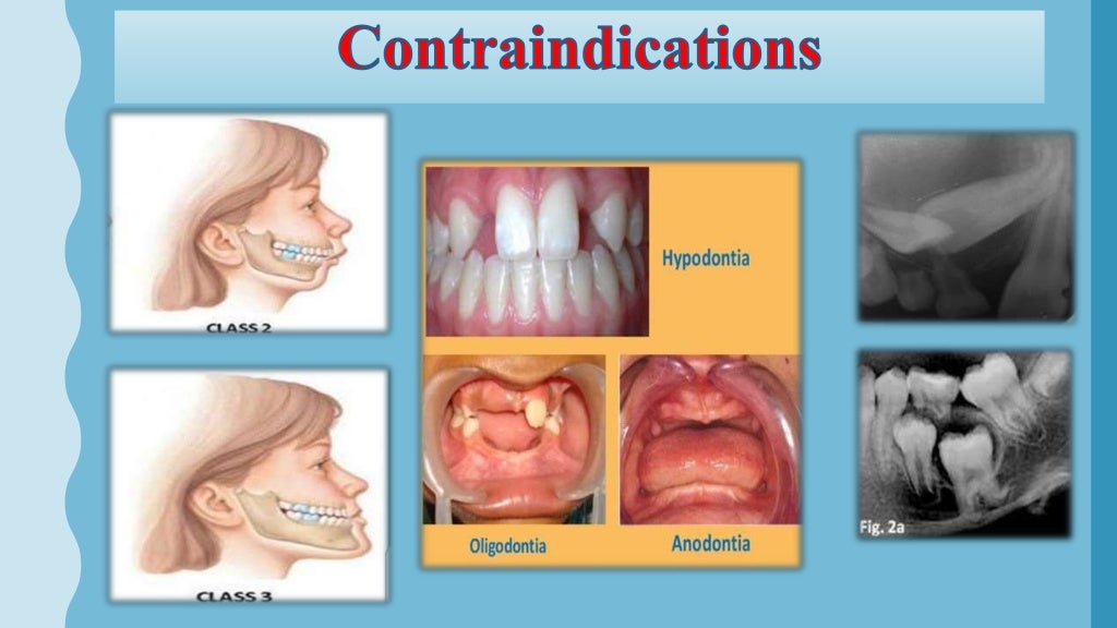 Interceptive orthodontics