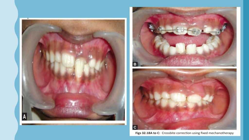 Interceptive orthodontics