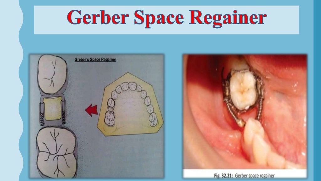 Interceptive orthodontics