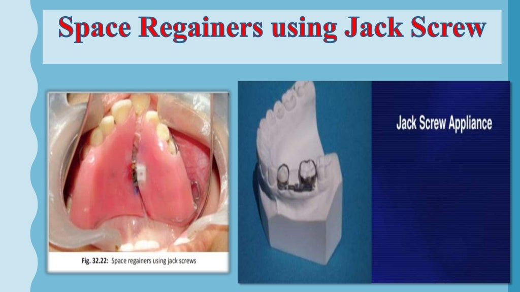Interceptive orthodontics