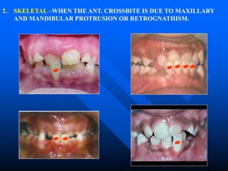 2. SKELETAL –WHEN THE ANT. CROSSBITE IS DUE TO MAXILLARY
AND MANDIBULAR PROTRUSION OR RETROGNATHISM.
 