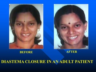 BEFORE AFTER
DIASTEMA CLOSURE IN AN ADULT PATIENT
 