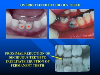 OVERRETAINED DECIDUOUS TEETH
PROXIMAL REDUCTION OF
DECIDUOUS TEETH TO
FACILITATE ERUPTION OF
PERMANENT TEETH
 