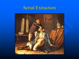 Serial Extraction
 