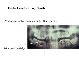 Lr6 Tooth Interceptive Orthodontics | PDF