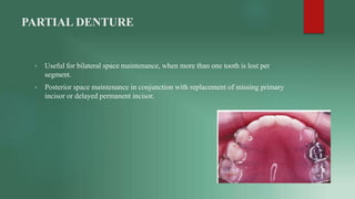 PARTIAL DENTURE
• Useful for bilateral space maintenance, when more than one tooth is lost per
segment.
• Posterior space ...