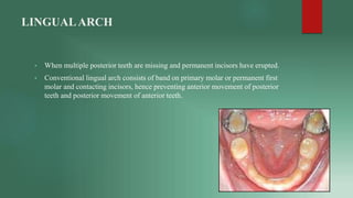 LINGUALARCH
• When multiple posterior teeth are missing and permanent incisors have erupted.
• Conventional lingual arch c...