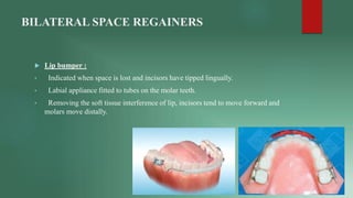 BILATERAL SPACE REGAINERS
 Lip bumper :
• Indicated when space is lost and incisors have tipped lingually.
• Labial appli...