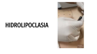 HIDROLIPOCLASIA
 