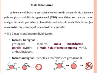 Mola Hidatiforme
A doença trofoblástica gestacional é constituída pela mola hidatiforme e
pela neoplasia trofoblástica gestacional (NTG); esta última se trata de tumor
maligno formado por células placentárias oriundas da mola hidatiforme (na
maioriadasvezes)oudequalqueroutrotipodegravidez.
• Ela é tradicionalmente dividida em:
• formas benignas -
gestações molares: mola hidatiforme
parcial (MHP) e mola hidatiforme completa (MHC),
ambas inviáveis;
• formas malignas - neoplasia trofoblástica gestacional.
 
