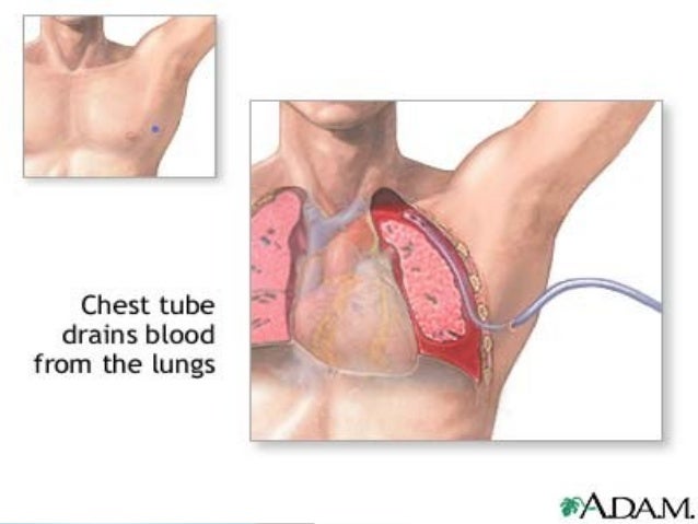 from fluid how drain lungs vaisakh drainage Inter costal from fluid how drain lungs vaisakh drainage Inter costal