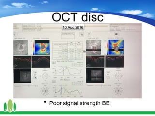 OCT disc
• Poor signal strength BE
10 Aug 2016
 