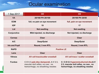 Ocular examination
OD OS
VA 20/160 PH 20/100 20/160 PH 20/50
EOM full, no pain on eye movement full, pain on eye movement
IOP 19 17
Lid Not swelling Not swelling
Conjunctiva Mild injected, no discharge Not injected, no discharge
Cornea Clear Clear
A/C Deep/Quiet Deep/Quiet
Iris and Pupil Round, 3 mm RTL Round, 3 mm RTL
RAPD Positive LE
Lens Clear Clear
Vitreos AV cell trace/scatter snowball AV cell trace / scatter snowball
Fundus C:D 0.3 pale disc (temporal), A:V 2:3,
macular dull reflex, no cws , no
hemorrhage, no sheathing vessles
C: C:D 0.3 hyperemia,blurred discA:V
2:3, macular dull reflex, no cws , no
hemorrhage, no sheathing vessles
1 Sep 2017
 