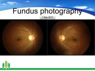 Fundus photography
1 Sep 2017
 
