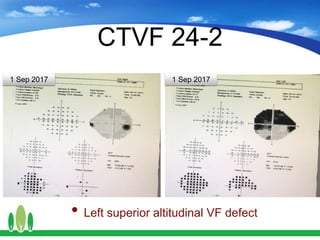 CTVF 24-2
• Left superior altitudinal VF defect
1 Sep 20171 Sep 2017
 