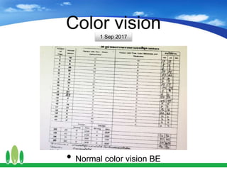 Color vision
• Normal color vision BE
1 Sep 2017
 