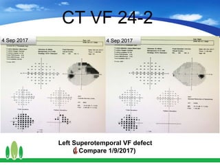 Left Superotemporal VF defect
( Compare 1/9/2017)
4 Sep 2017
CT VF 24-2
4 Sep 2017
 