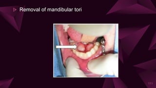 ⩥ Removal of mandibular tori
111
 