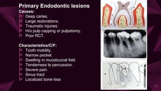 Primary Endodontic lesions
Causes:
⩥ Deep caries.
⩥ Large restorations.
⩥ Traumatic injuries.
⩥ H/o pulp capping or pulpotomy.
⩥ Poor RCT.
Characteristics/C/F:
⩥ Tooth mobility.
⩥ Narrow pocket.
⩥ Swelling in mucobuccal fold.
⩥ Tenderness to percussion.
⩥ Severe pain
⩥ Sinus tract
⩥ Localized bone loss
27
 