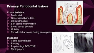Primary Periodontal lesions
Characteristics
⩥ Teeth vital
⩥ Generalized bone loss
⩥ Calculus/plaque
⩥ Soft tissue inflammation
⩥ Broad based pockets
⩥ Mobility
⩥ Periodontal abscess during acute phase
Diagnosis
⩥ Visual examination
⩥ Probing
⩥ Pulp testing- POSITIVE
⩥ Radiographs 32
 