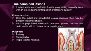 True combined lesions
⩥ It arises when an endodontic disease progressing coronally joins
with an infected periodontal pocket progressing apically.
Characteristics
⩥ Once the pulpal and periodontal lesions coalesce, they may be
clinically indistinguishable.
⩥ Necrotic pulp/ failed endodontic treatment, plaque, calculus and
periodontitis will be present in varying degrees.
Diagnosis
⩥ Probing
⩥ Radiographs
⩥ Pulpal testing: negative.
37
 