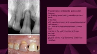 39
True combined endodontic–periodontal
disease.
(A) Radiograph showing bone loss in two-
thirds
of the root
with calculus present and separate periapical
radiolucency.
(B) Clinical examination revealed coronal
color
change of the tooth involved and pus
exuding
from the
gingival crevis. Pulp-sensitivity tests were
negative.
 