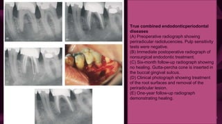 40
True combined endodonticperiodontal
diseases
(A) Preoperative radiograph showing
periradicular radiolucencies. Pulp sensitivity
tests were negative.
(B) Immediate postoperative radiograph of
nonsurgical endodontic treatment.
(C) Six-month follow-up radiograph showing
no healing. Gutta-percha cone is inserted in
the buccal gingival sulcus.
(D) Clinical photograph showing treatment
of the root surfaces and removal of the
periradicular lesion.
(E) One-year follow-up radiograph
demonstrating healing.
 