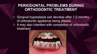 PERIODONTAL PROBLEMS DURING
ORTHODONTIC TREATMENT
⩥ Gingival hyperplasia can develop after 1-2 months
of orthodontic appliance being placed.
⩥ It may also interfere with completion of orthodontic
treatment
44
 
