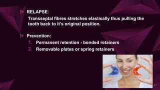 ⩥ RELAPSE:
Transseptal fibres stretches elastically thus pulling the
tooth back to it’s original position.
⩥ Prevention:
1. Permanent retention - bonded retainers
2. Removable plates or spring retainers
47
 