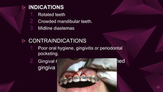 ⩥ INDICATIONS
1. Rotated teeth
2. Crowded mandibular teeth.
3. Midline diastemas
⩥ CONTRAINDICATIONS
1. Poor oral hygiene, gingivitis or periodontal
pocketing.
2. Gingival recession or lack of attached
gingiva
58
 