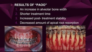 ⩥ RESULTS OF “PAOO”
1. An increase in alveolar bone width
2. Shorter treatment time
3. Increased post- treatment stability
4. Decreased amount of apical root resorption
60
 