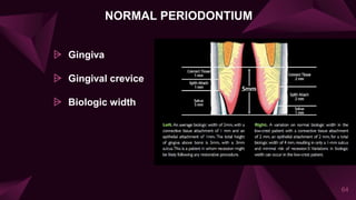 NORMAL PERIODONTIUM
⩥ Gingiva
⩥ Gingival crevice
⩥ Biologic width
64
 