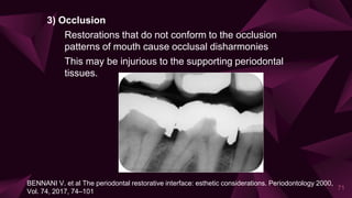3) Occlusion
Restorations that do not conform to the occlusion
patterns of mouth cause occlusal disharmonies
This may be injurious to the supporting periodontal
tissues.
71
BENNANI V. et al The periodontal restorative interface: esthetic considerations. Periodontology 2000,
Vol. 74, 2017, 74–101
 